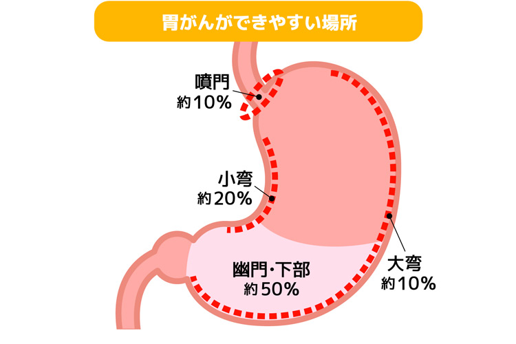 胃がんができやすい場所イメージイラスト